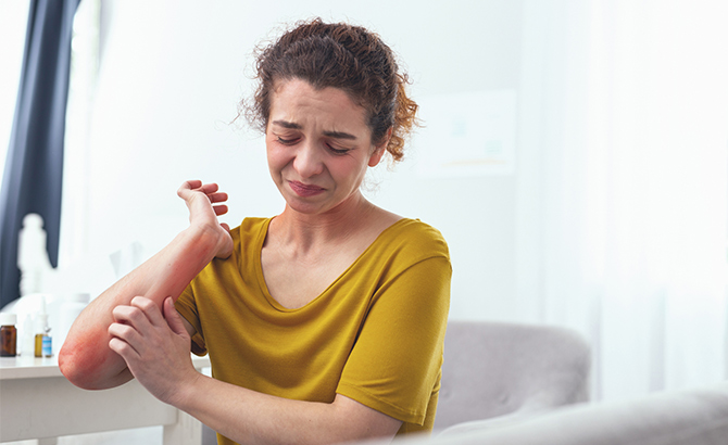L’eczéma : une maladie de la peau plus répandue qu’on ne le croit